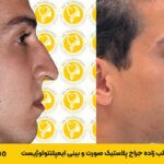 عمل بینی استخوانی1402