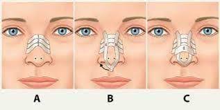 نحوه چسب زدن بینی بعد از عمل بینی
